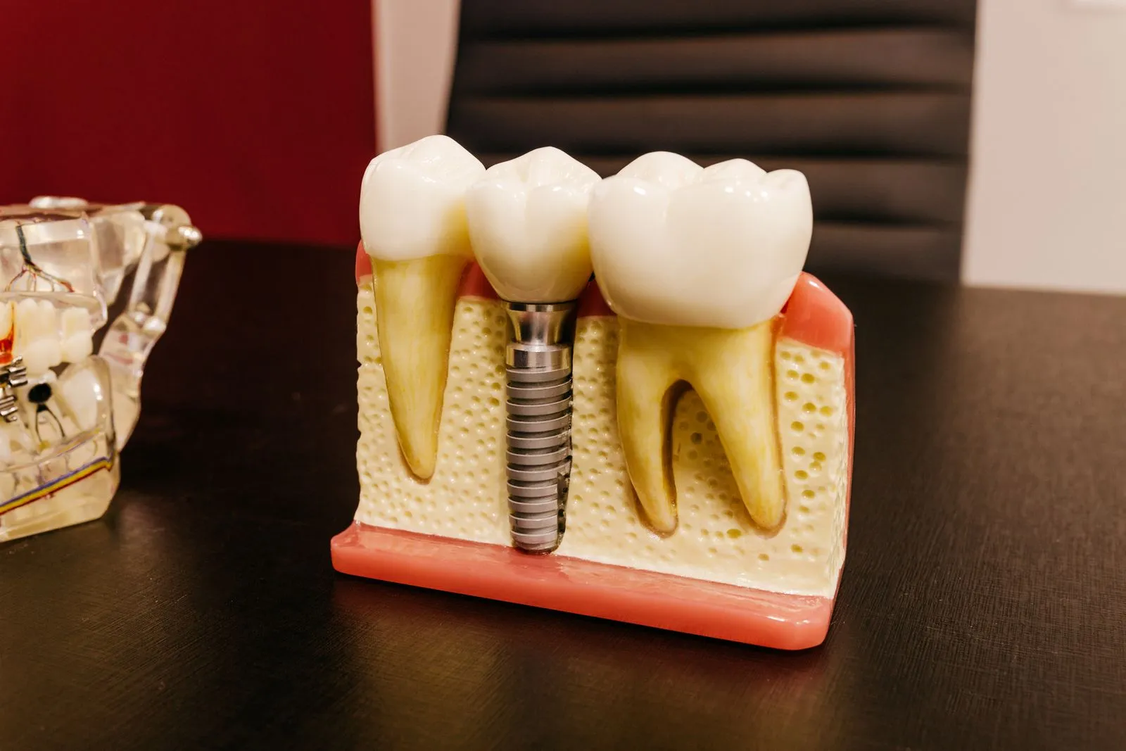 Modelo de implante dental de titanio junto a piezas naturales